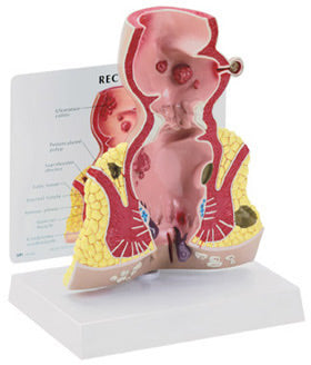 Rectum Budget Model