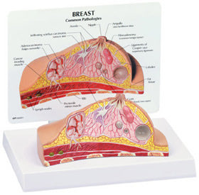 Breast Cross Section Budget Model Showing Pathologies