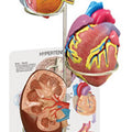 Hypertension Model Set Budget Range