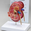 Kidney Cancer Oversize - Budget Model