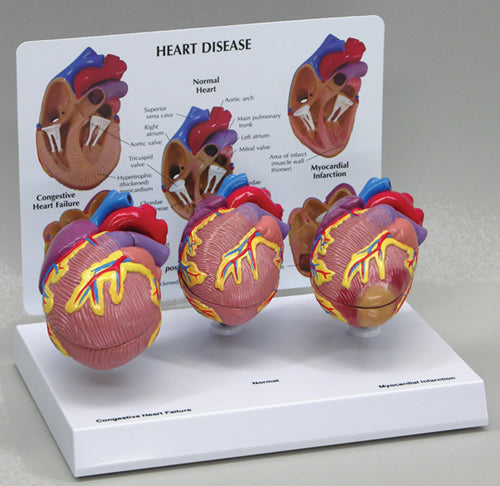 3-Mini Heart Set - Budget Model