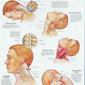 Whiplash Injuries Head & Neck