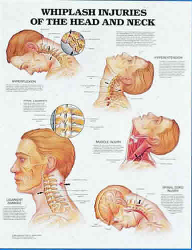 Whiplash Injuries Head & Neck