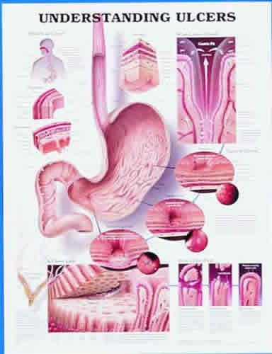 Understanding Ulcers Chart