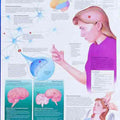 Understand Epilepsy Chart