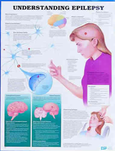 Understand Epilepsy Chart