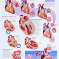 Heart Disease Chart