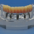 Mini-Implant Mandible