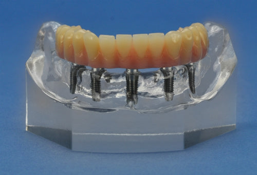 Mini-Implant Mandible