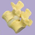 Vertebral Joint,Slipped Disc