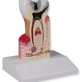 Dental Caries Model, 10x Life Size