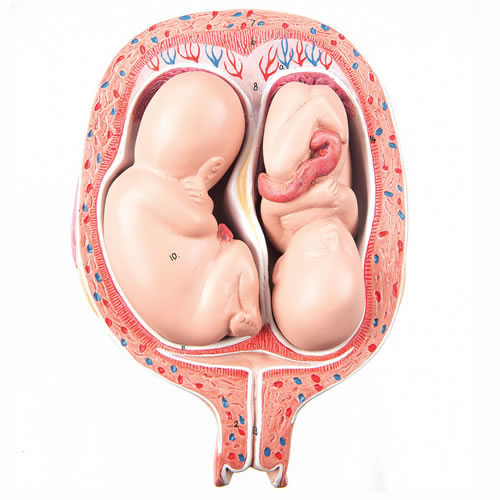 Twin Foetuses In 5th Month